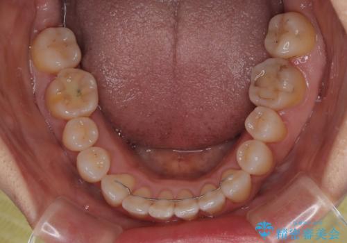 骨格的なズレを歯列矯正でカバー ワイヤー装置での非抜歯矯正の治療後