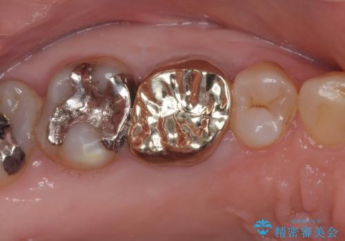 銀歯の下のむし歯 ゴールドクラウンによる補綴治療の症例 治療後