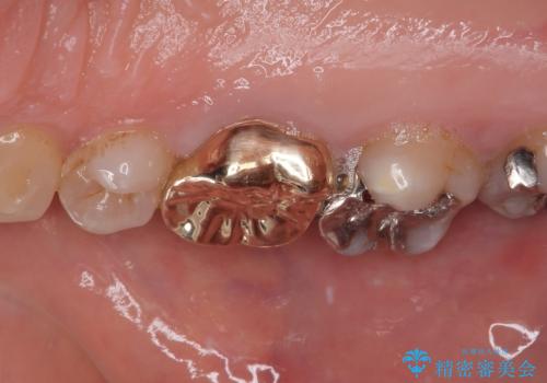 銀歯の下のむし歯 ゴールドクラウンによる補綴治療の治療後