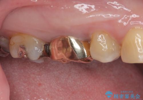 銀歯の下のむし歯 ゴールドクラウンによる補綴治療の治療後