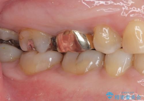 銀歯の下のむし歯 ゴールドクラウンによる補綴治療の治療後