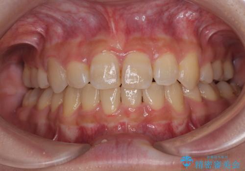 気になる八重歯 ワイヤー装置での抜歯矯正の症例 治療後