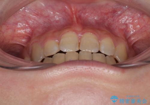 気になる八重歯 ワイヤー装置での抜歯矯正の治療後