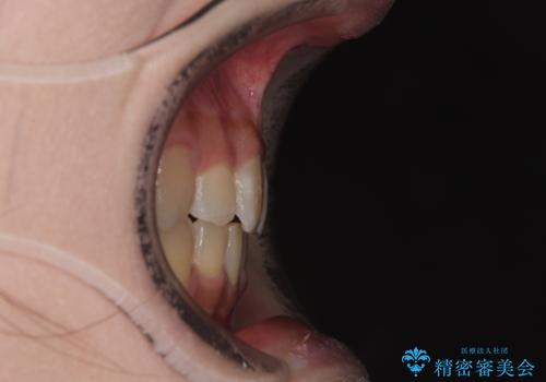 気になる八重歯 ワイヤー装置での抜歯矯正の治療後