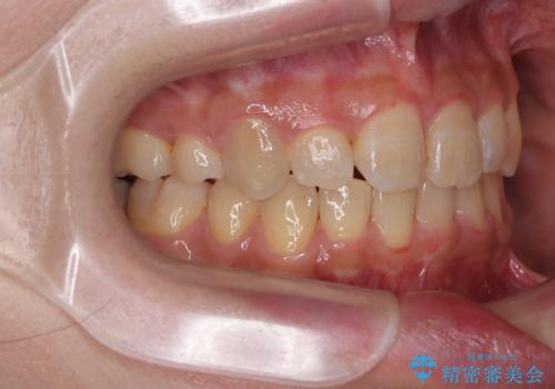 気になる八重歯 ワイヤー装置での抜歯矯正の治療後