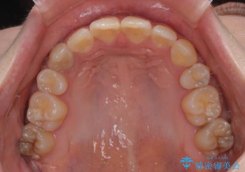 気になる八重歯 ワイヤー装置での抜歯矯正の治療後