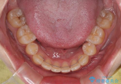 気になる八重歯 ワイヤー装置での抜歯矯正の治療後