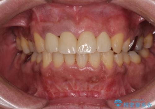 前歯の審美歯科治療 下顎の部分矯正と上顎前歯のオールセラミッククラウンの症例 治療後