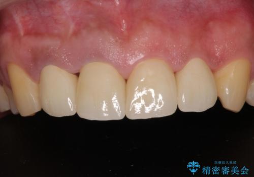 前歯の審美歯科治療 下顎の部分矯正と上顎前歯のオールセラミッククラウンの治療後