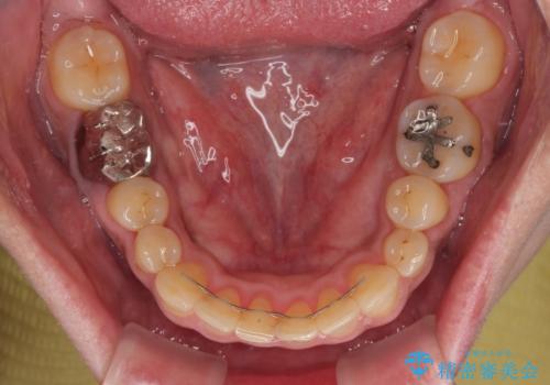 前歯の審美歯科治療 下顎の部分矯正と上顎前歯のオールセラミッククラウンの治療後