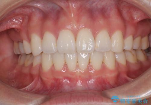 唇を閉じて眠れない ワイヤー装置での抜歯矯正で口元をスッキリとの治療後