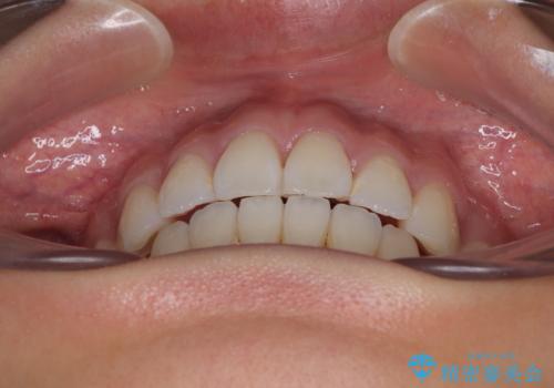 唇を閉じて眠れない ワイヤー装置での抜歯矯正で口元をスッキリとの治療後