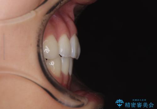 唇を閉じて眠れない ワイヤー装置での抜歯矯正で口元をスッキリとの治療後