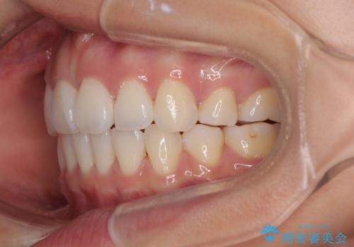 唇を閉じて眠れない ワイヤー装置での抜歯矯正で口元をスッキリとの治療後