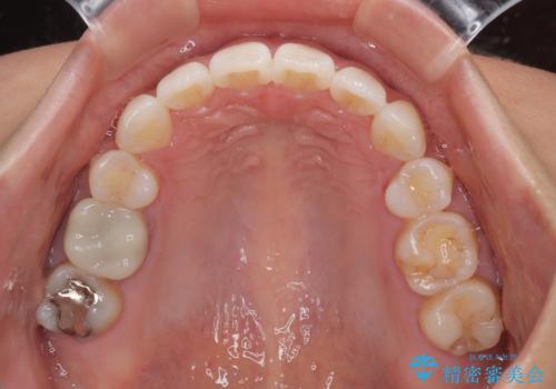 唇を閉じて眠れない ワイヤー装置での抜歯矯正で口元をスッキリとの治療後