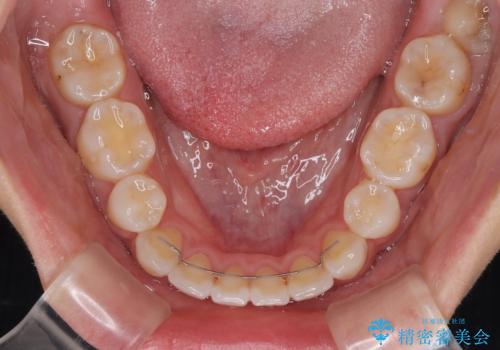 唇を閉じて眠れない ワイヤー装置での抜歯矯正で口元をスッキリとの治療後