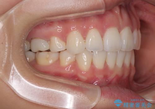 唇を閉じて眠れない ワイヤー装置での抜歯矯正で口元をスッキリとの治療後