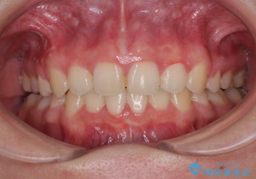 飛び出した口元を改善したい ワイヤー装置による抜歯矯正治療の症例 治療後