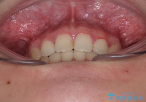 飛び出した口元を改善したい ワイヤー装置による抜歯矯正治療の治療後