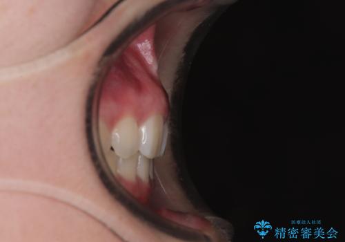 飛び出した口元を改善したい ワイヤー装置による抜歯矯正治療の治療後