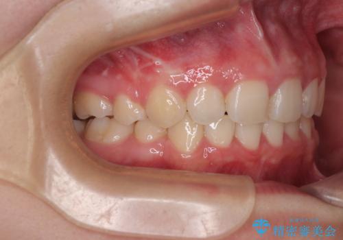 飛び出した口元を改善したい ワイヤー装置による抜歯矯正治療の治療後