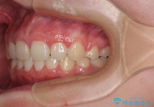 飛び出した口元を改善したい ワイヤー装置による抜歯矯正治療の治療後