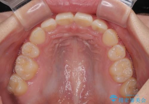 飛び出した口元を改善したい ワイヤー装置による抜歯矯正治療の治療後