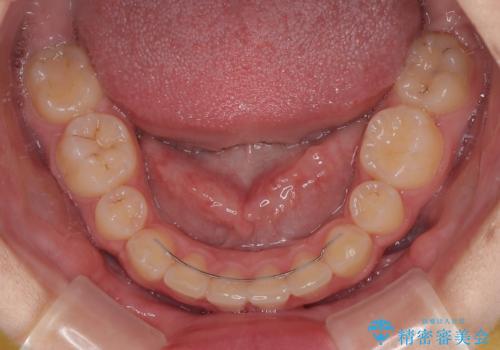 飛び出した口元を改善したい　ワイヤー装置による抜歯矯正治療の治療後