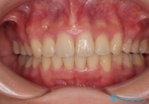 全顎的なデコボコと口元の突出感 ワイヤー装置での抜歯矯正で整った口元にの症例 治療後