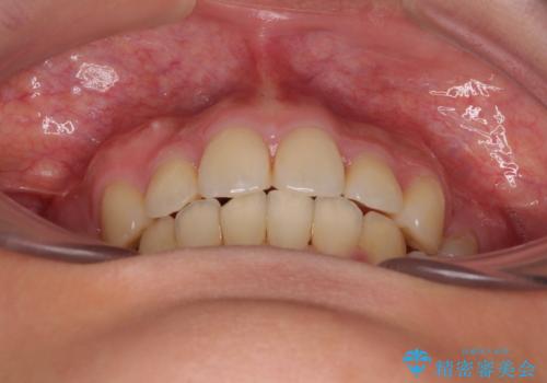 全顎的なデコボコと口元の突出感 ワイヤー装置での抜歯矯正で整った口元にの治療後