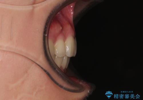 全顎的なデコボコと口元の突出感 ワイヤー装置での抜歯矯正で整った口元にの治療後