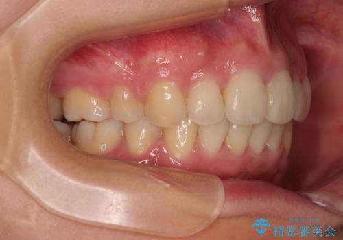 全顎的なデコボコと口元の突出感 ワイヤー装置での抜歯矯正で整った口元にの治療後