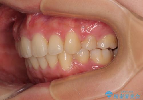 全顎的なデコボコと口元の突出感 ワイヤー装置での抜歯矯正で整った口元にの治療後