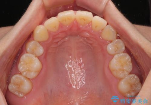 全顎的なデコボコと口元の突出感 ワイヤー装置での抜歯矯正で整った口元にの治療後