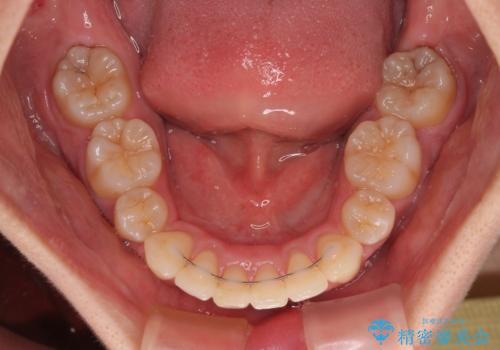 全顎的なデコボコと口元の突出感 ワイヤー装置での抜歯矯正で整った口元にの治療後