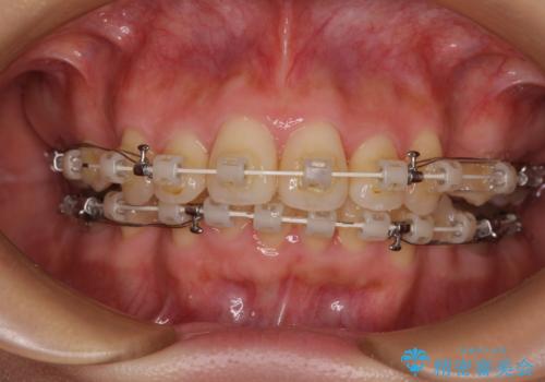 全顎的なデコボコと口元の突出感 ワイヤー装置での抜歯矯正で整った口元にの治療中