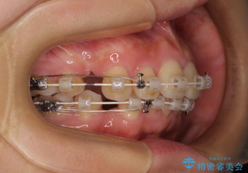 全顎的なデコボコと口元の突出感 ワイヤー装置での抜歯矯正で整った口元にの治療中