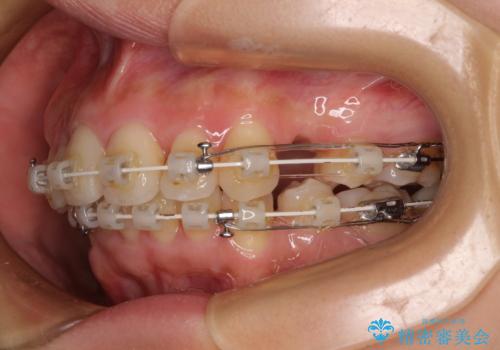 全顎的なデコボコと口元の突出感 ワイヤー装置での抜歯矯正で整った口元にの治療中