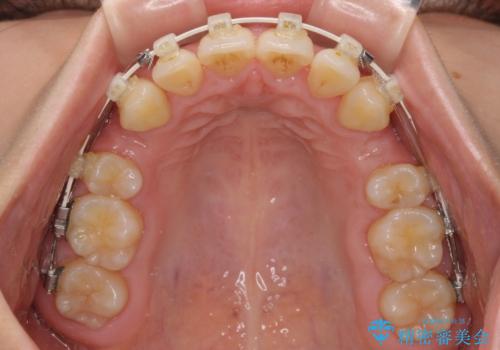 全顎的なデコボコと口元の突出感 ワイヤー装置での抜歯矯正で整った口元にの治療中