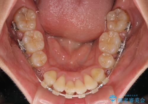 全顎的なデコボコと口元の突出感 ワイヤー装置での抜歯矯正で整った口元にの治療中