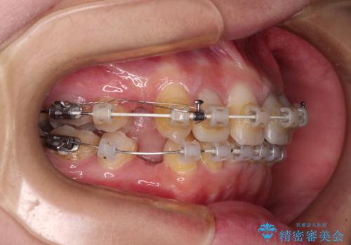 気になっていたむし歯と前歯のデコボコ 矯正治療とむし歯治療の総合歯科治療の治療中