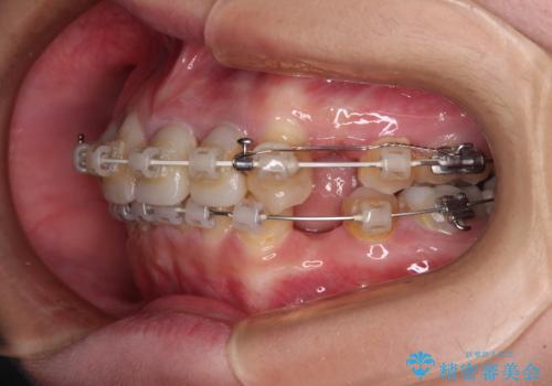 気になっていたむし歯と前歯のデコボコ 矯正治療とむし歯治療の総合歯科治療の治療中