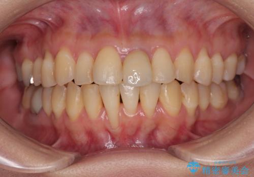 矯正治療で退縮した歯肉 歯肉移植術で露出した歯根を覆い隠すの治療前