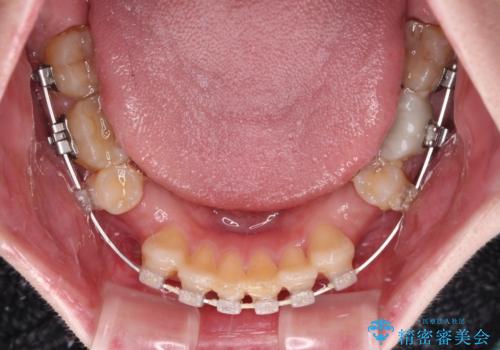 気になっていたむし歯と前歯のデコボコ 矯正治療とむし歯治療の総合歯科治療の治療中