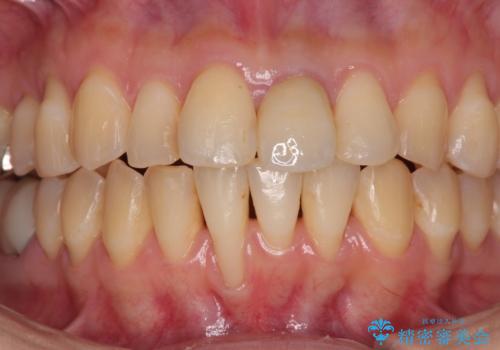 矯正治療で退縮した歯肉 歯肉移植術で露出した歯根を覆い隠すの治療前