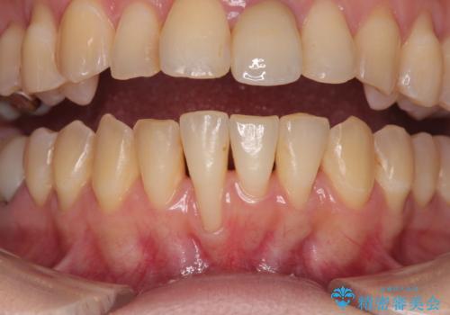 矯正治療で退縮した歯肉 歯肉移植術で露出した歯根を覆い隠すの症例 治療前