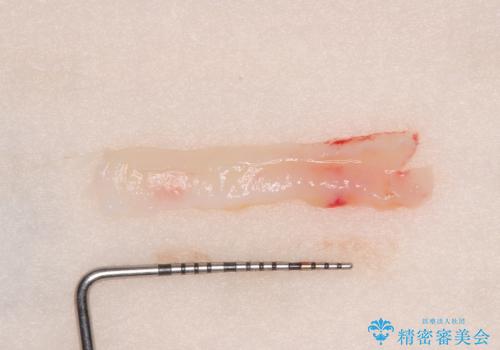 矯正治療で退縮した歯肉　歯肉移植術で露出した歯根を覆い隠すの治療後