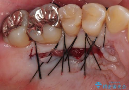 矯正治療で退縮した歯肉 歯肉移植術で露出した歯根を覆い隠すの治療中