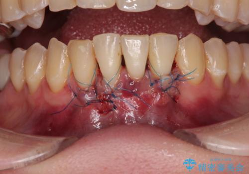 矯正治療で退縮した歯肉 歯肉移植術で露出した歯根を覆い隠すの治療前
