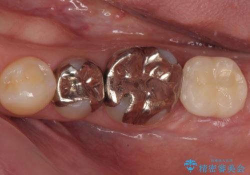 奥歯に歯を入れたい 即時荷重インプラントによる短期間インプラント治療の症例 治療後
